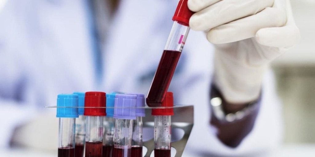 Alzheimer análisis de sangre, cepa de India