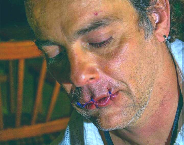 Artista colombiano se cose la boca como protesta contra Duque
