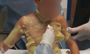 Menores rocían de alcohol y prenden fuego a otro jovencito provocándole graves quemaduras