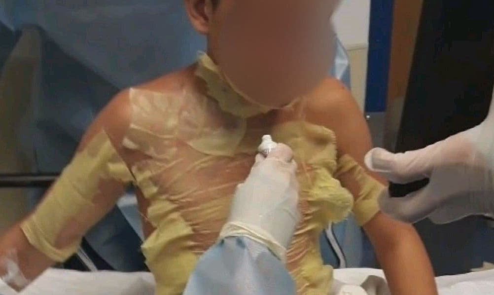 Menores rocían de alcohol y prenden fuego a otro jovencito provocándole graves quemaduras.