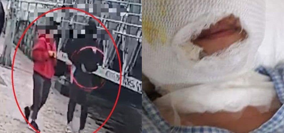 Lanzan ácido a una joven en plena vía pública, su novio fue el que planeó el ataque .