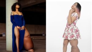 Mahogany, la chica con elefantiasis  que sueña con ser modelo