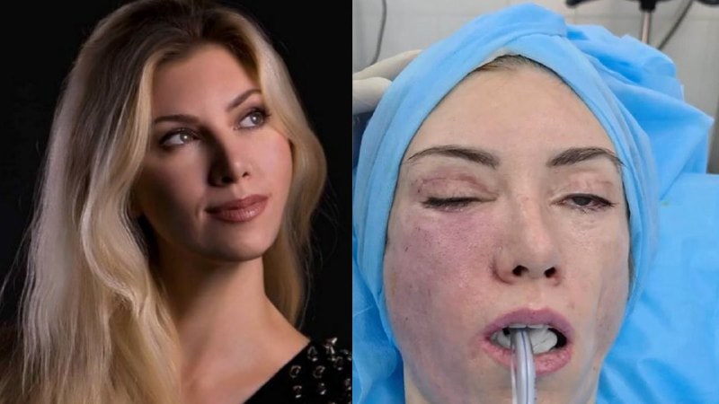 Denuncian a cirujanos que desfiguraron el rostro de una reina de belleza rusa