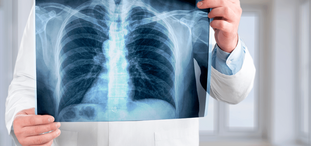 Encuentran más de 39 partículas de microplástico en pulmones humanos, punto débil