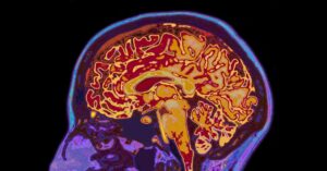 El bilingüismo podría prevenir la demencia, según un nuevo estudio