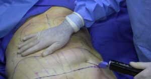 Muere después de realizarse una liposucción en sí misma