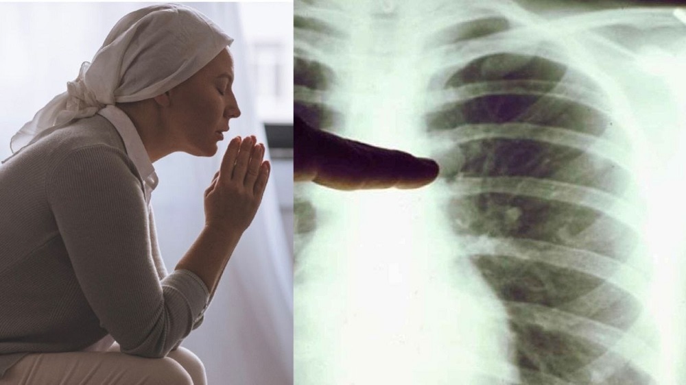 Médicos le extirpan un pulmón por mal diagnóstico de cáncer y ahora deben pagar $120 mil dólares
