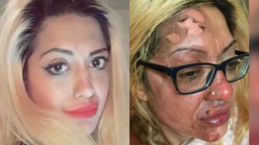 Mujer sufre graves quemaduras en su cara por hacer un reto viral de TikTok