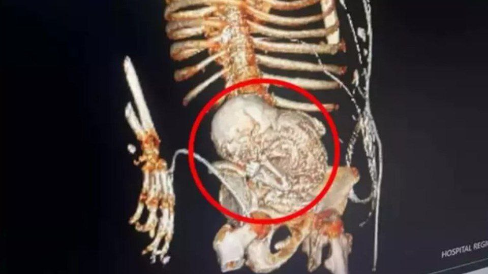 Anciana muere luego que le extraen feto calcificado que llevó en su vientre por 30 años
