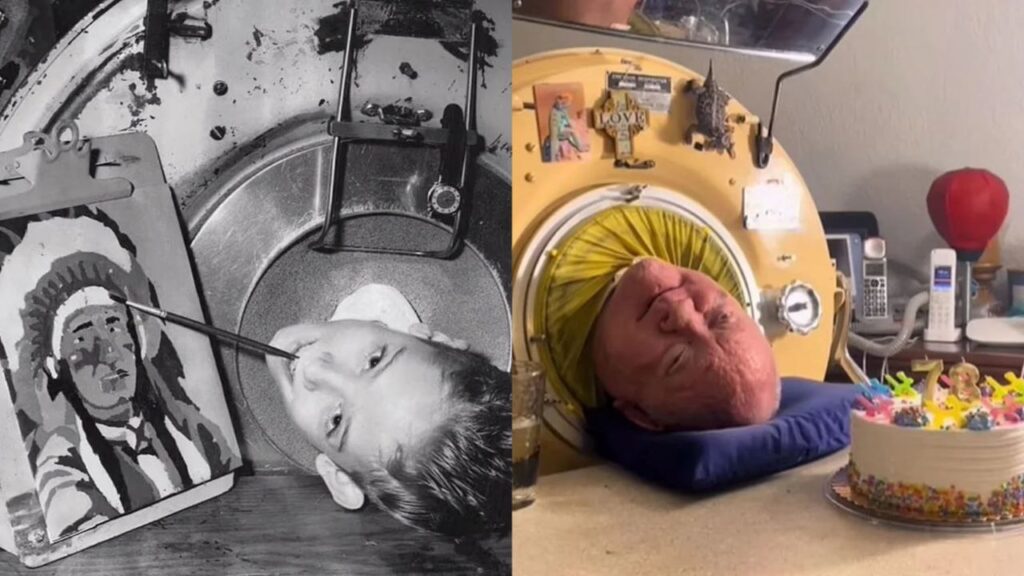 Muere el hombre que vivió en un pulmón de acero por 70 años