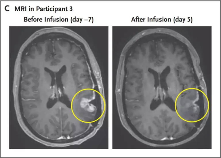 cancer tumor cancer cerebral