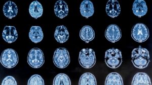 Investigación científica muestra el impacto de los anticonceptivos en el cerebro